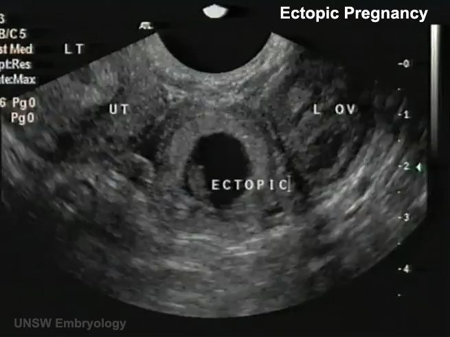 👍 ultrasound guidelines for pregnancy