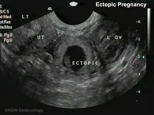 Transvaginal Ultrasound: Necessary for Your Medical